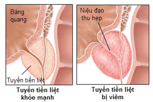 Tuyến tiền liệt ở nam giới