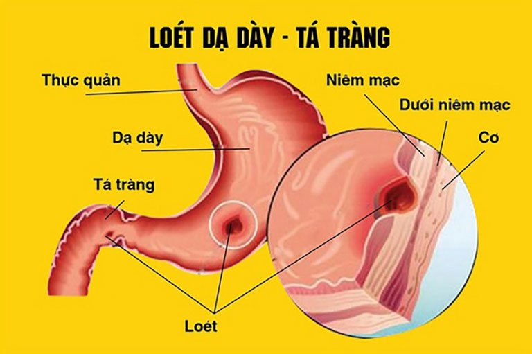 Cần làm gì khi bị Viêm loét Dạ dày - Tá tràng?