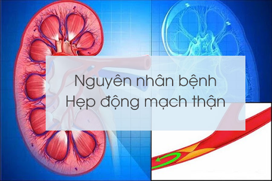 Nguyên nhân bệnh Hẹp động mạch thận