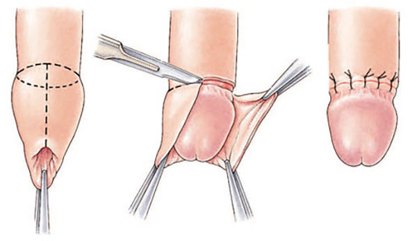 Lợi ích của việc cắt bao đầu quy