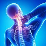 Bệnh thoái hóa đốt sống cổ – Những điều nhất định phải biết