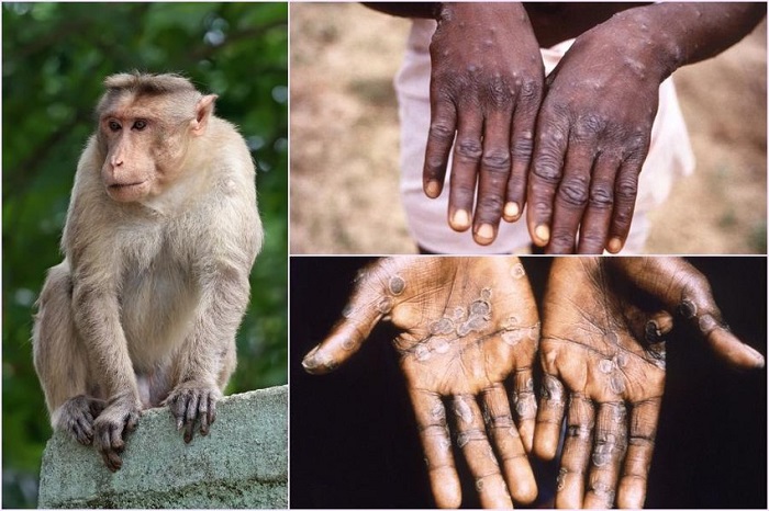 WHO đánh giá nguy cơ bệnh đậu mùa khỉ lây lan qua đường tình dục