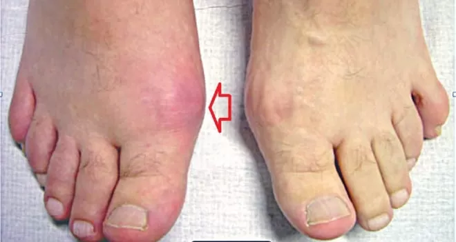 Bị Gout vì uống bia hằng ngày gây dịch màu trà sữa ở khớp gối