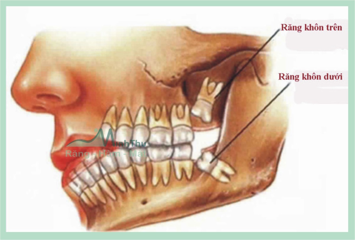 Những biến chứng của răng khôn thường gặp nhất