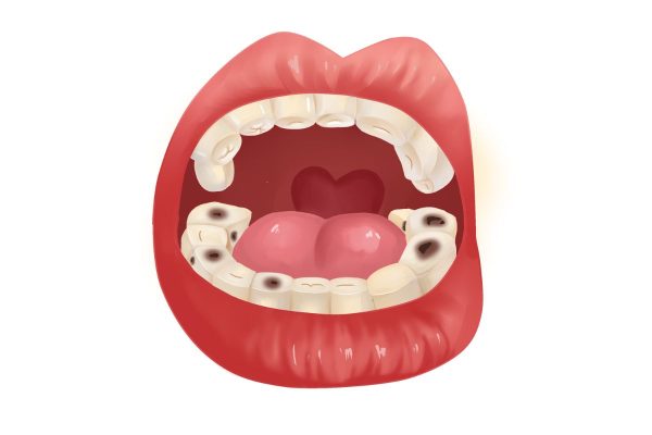 Các phương pháp trị sâu răng vĩnh viễn, hiệu quả cao