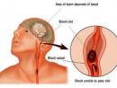 Tai biến mạch máu não và cách sơ cứu ban đầu