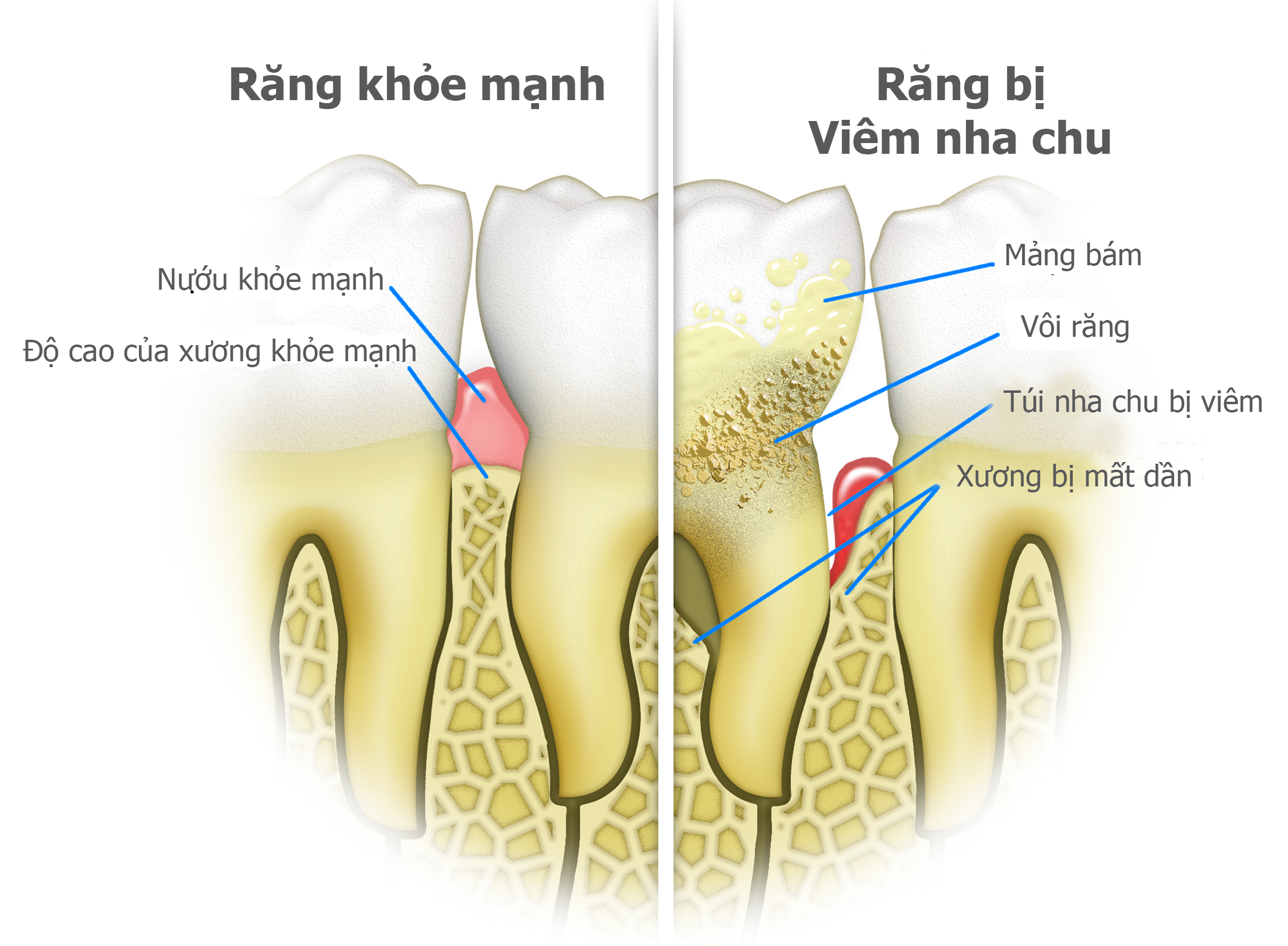 Viêm nha chu có phải là bệnh không ?