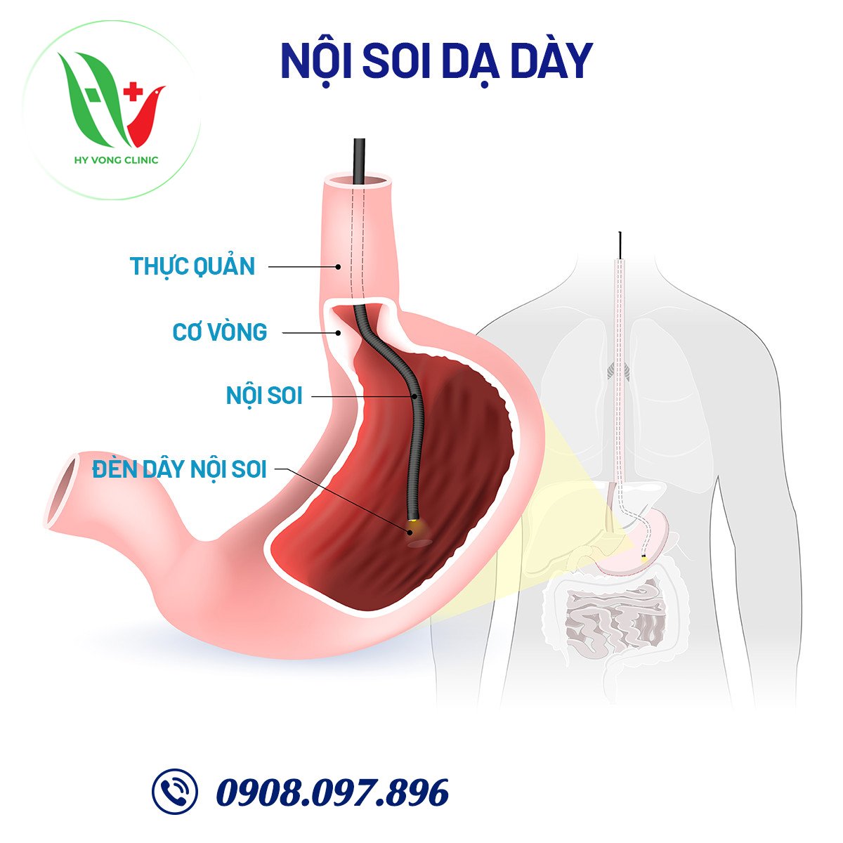 Vi khuẩn HP trong dạ dày có nguy hiểm không?