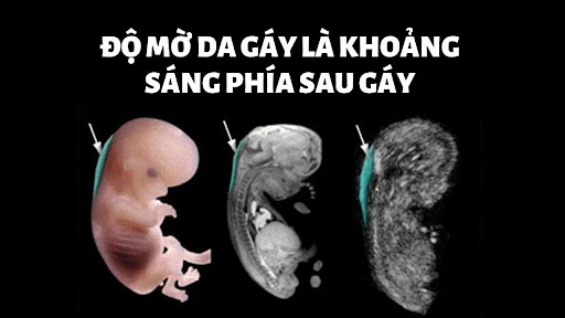 Độ mờ da gáy Độ mờ da gáy