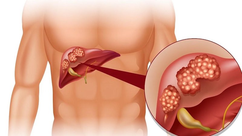 Đau bụng phải là triệu chứng của viêm gan virus mạn