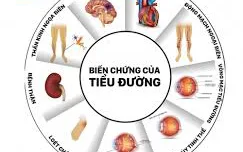 13 điều cần phải biết về TIỂU ĐƯỜNG và các BIẾN CHỨNG