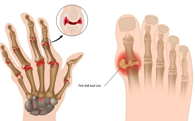 5 HIỂU NHẦM THƯỜNG GẶP VỀ LOÃNG XƯƠNG