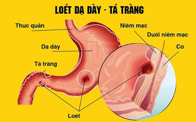 Loét "Dạ dày - Tá Tràng" và những điều bạn cần biết !!!