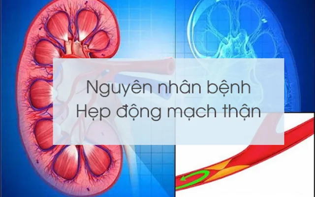 Nguyên nhân bệnh Hẹp động mạch thận