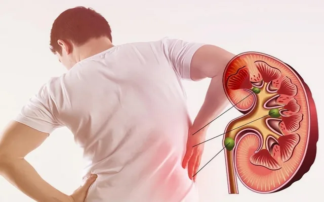Phát hiện dấu hiệu sỏi thận, cần làm gì?