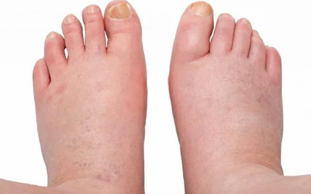 Dấu hiệu dễ nhận biết khi thận của bạn đang có vấn đề