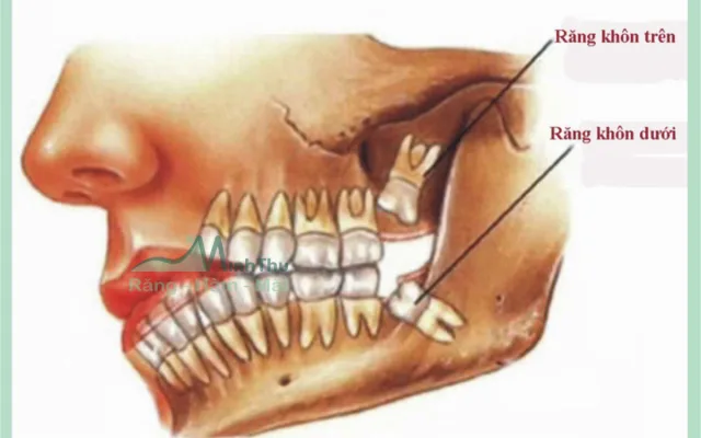 Những biến chứng của răng khôn thường gặp nhất