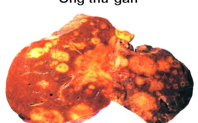 Ung thư gan - Nhừng điều cần biết