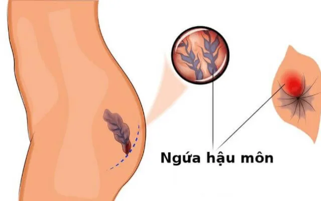 Cách phân biệt ung thư đại trực tràng với bệnh trĩ giúp nhiều người xóa tan lầm tưởng