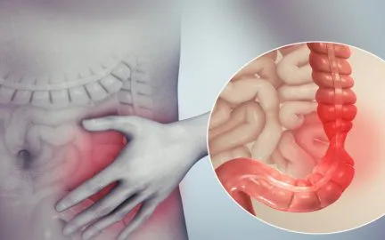 Hiểu đúng về bệnh viêm đại tràng co thắt