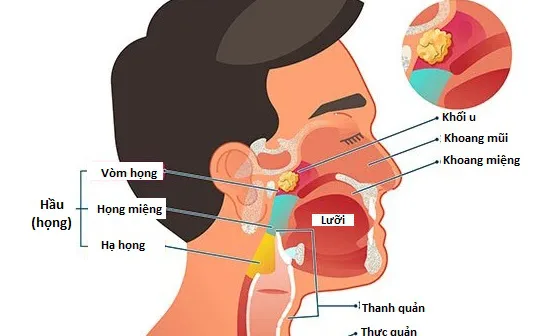 Ung thư vòm mũi họng - Nguyên nhân, chẩn đoán và phác đồ điều trị