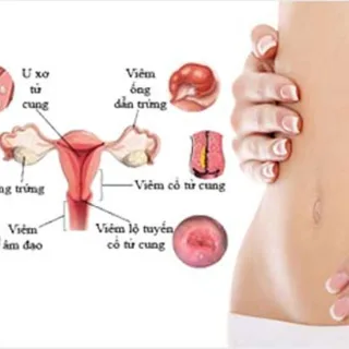 Các bệnh phụ khoa thường gặp