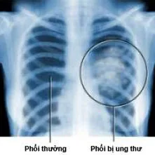 Ung thư phổi và nhừng điều nên biết