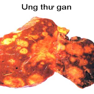 Ung thư gan - Nhừng điều cần biết