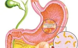 Dấu hiệu điển hình của đau dạ dày