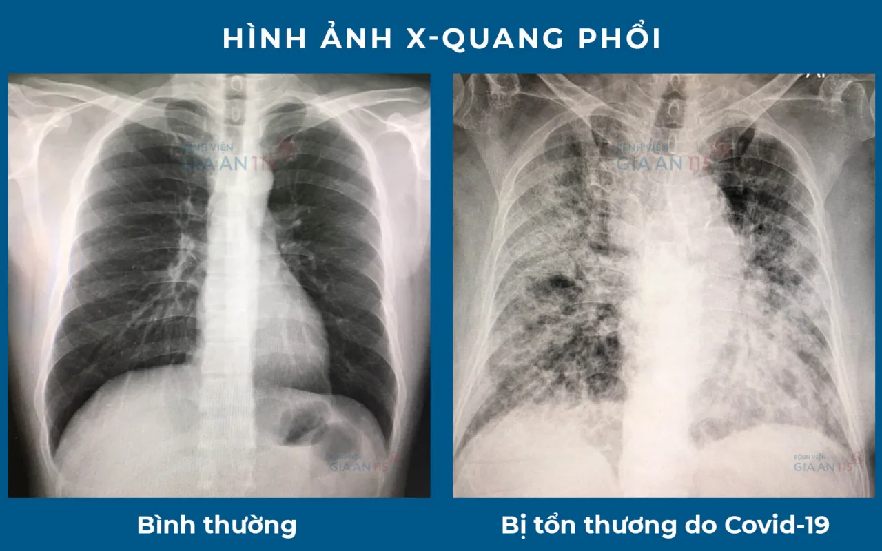 Kiểm tra Phổi hậu Covid-19 - CT Scanner Phổi liều thấp