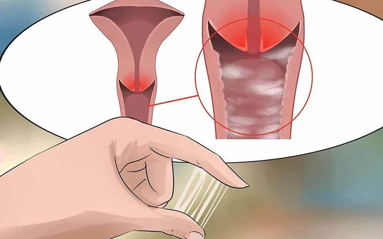 BỆNH VIÊM ÂM ĐẠO LÀ GÌ? DẤU HIỆU NHẬN BIẾT VÀ CÁCH ĐIỀU TRỊ ĐÚNG