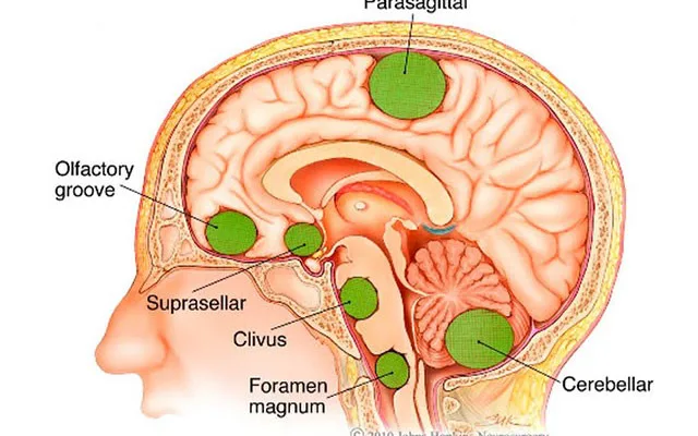 Những dấu hiệu và triệu chứng cảnh báo bệnh u não