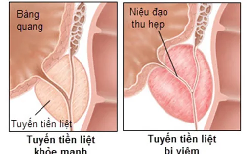 Tuyến tiền liệt ở nam giới