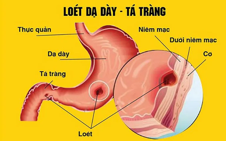 Loét "Dạ dày - Tá Tràng" và những điều bạn cần biết !!!