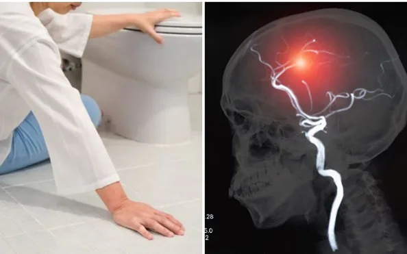 5 dấu hiệu đột quỵ cần lưu ý