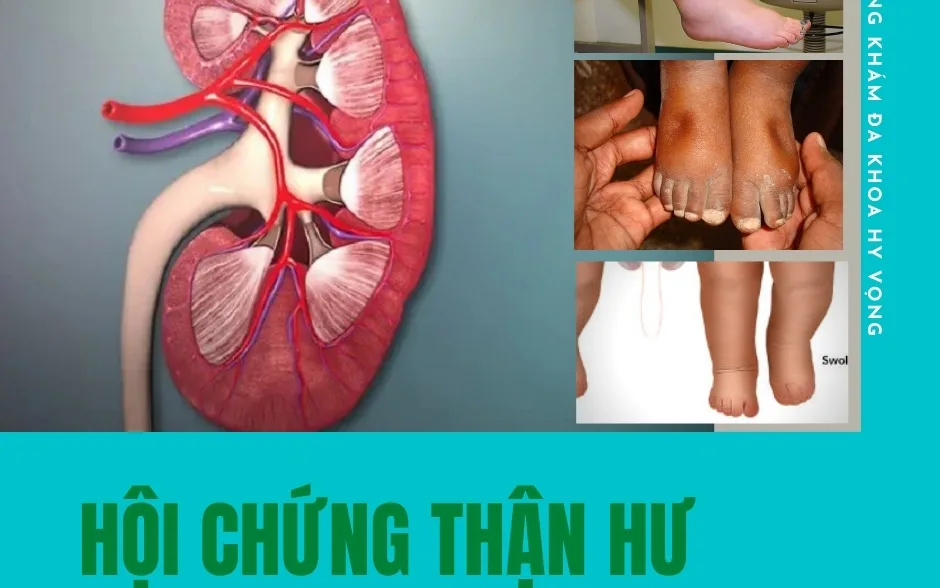 Hội chứng thận hư: Chẩn đoán và điều trị