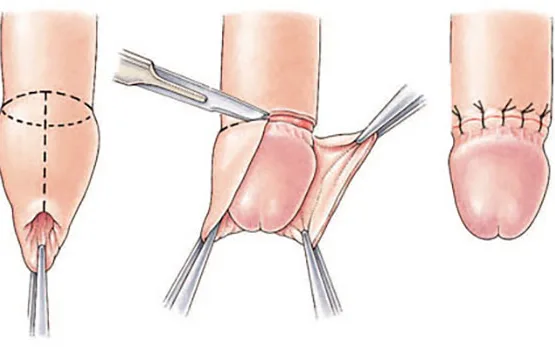 Lợi ích của việc cắt bao đầu quy