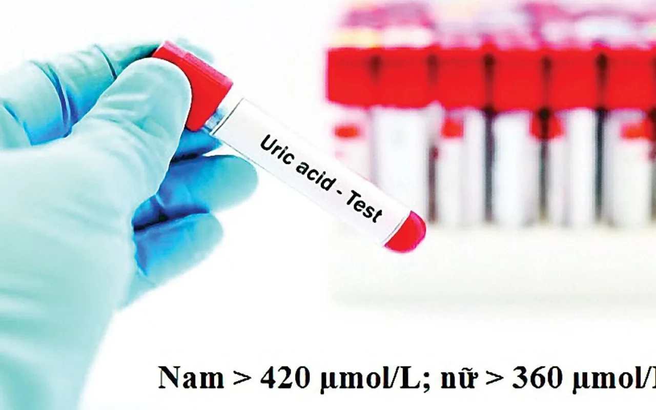 Nồng độ acid uric trong máu tăng là do những nguyên nhân nào?