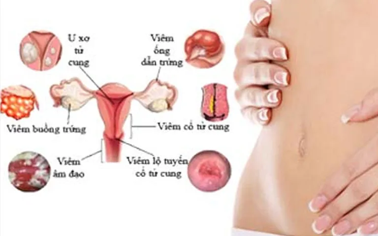 Các bệnh phụ khoa thường gặp