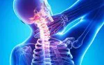 Bệnh thoái hóa đốt sống cổ – Những điều nhất định phải biết