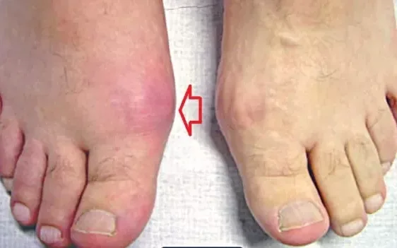 Bị Gout vì uống bia hằng ngày gây dịch màu trà sữa ở khớp gối