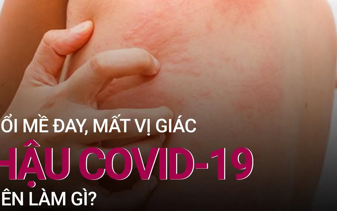 Tình trạng nổi mày đay hậu Covid-19 - Cách chữa trị