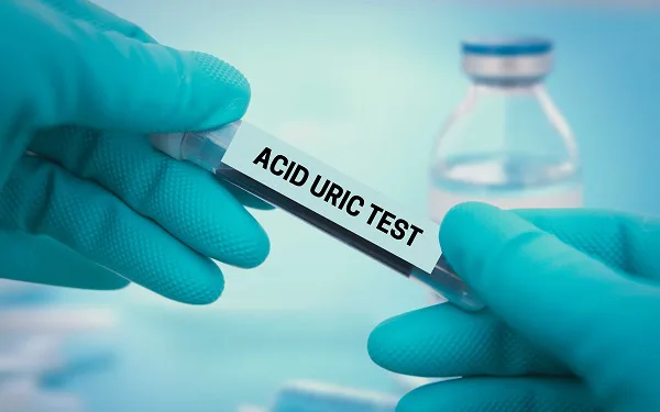 XÉT NGHIỆM ACID URIC MÁU ĐỂ LÀM GÌ