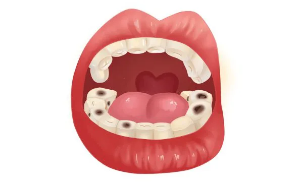 Các phương pháp trị sâu răng vĩnh viễn, hiệu quả cao