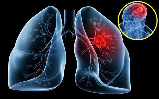 5 dấu hiệu sớm của ung thư phổi bạn cần biết