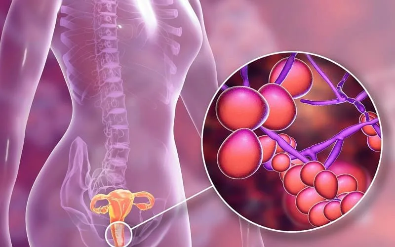 Viêm âm đạo do tạp khuẩn ở nữ giới và cách điều trị