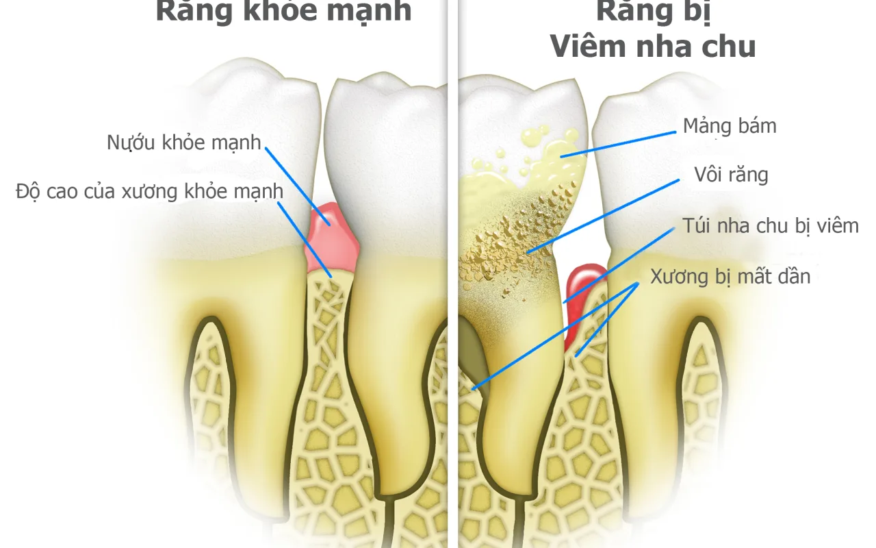 Viêm nha chu có phải là bệnh không ?