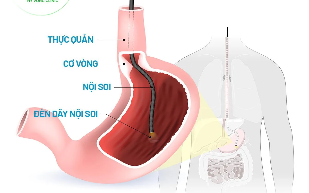 Vi khuẩn HP trong dạ dày có nguy hiểm không?